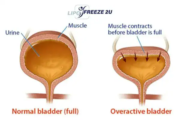diagram of overactive bladder treatment Watford
