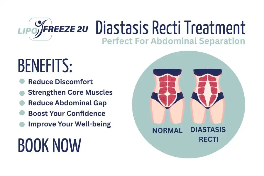 Benefits of body toning treatment Watford for Diastasis recti