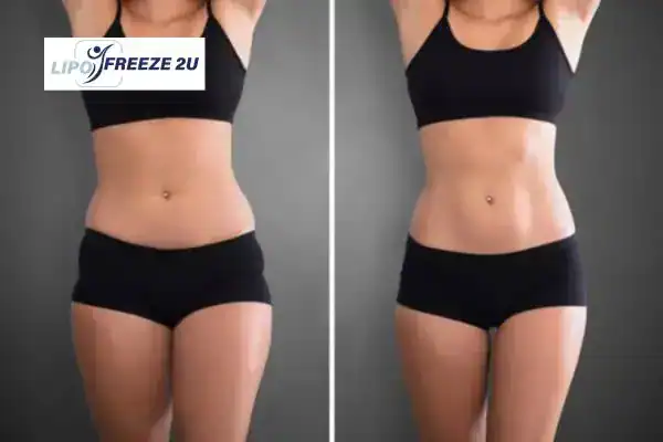 How Can LIPO FREEZE 2U Support Your Post-Pregnancy Body Recovery Watford?