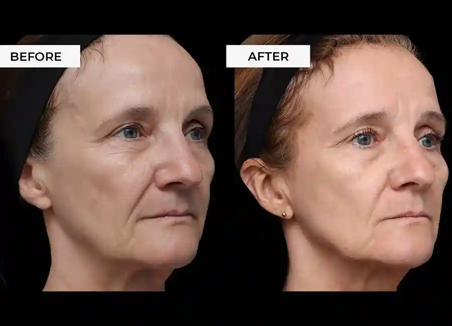 How Many RF Microneedling Sessions Will You Need to See a Difference Watford?