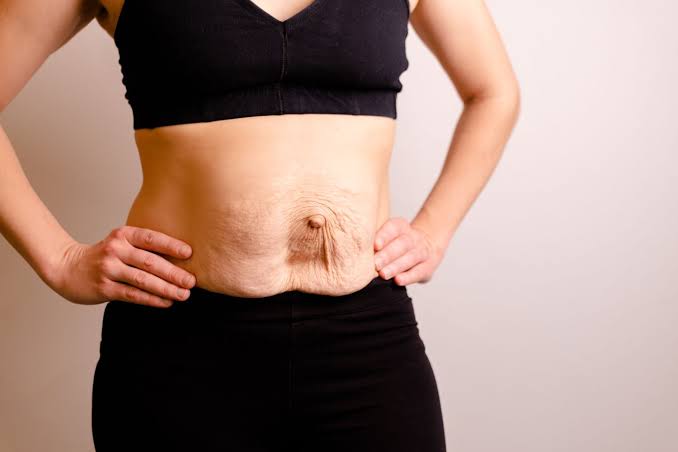 Is Surgery Really the Only Way to Repair Diastasis Recti Watford?