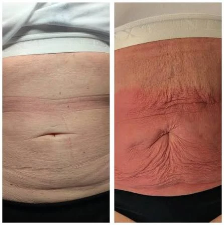 How Does RF Microneedling Improve Crepey, Thin and Uneven Skin Texture Watford?