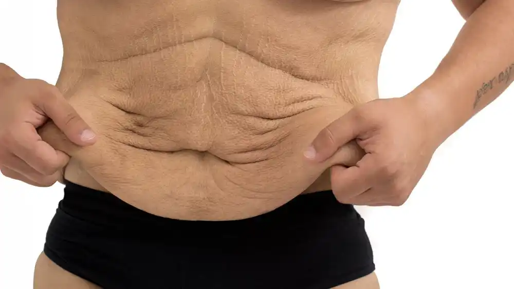 Why Does Weight Loss Medication Leave Some People With Loose or Sagging Skin Watford?